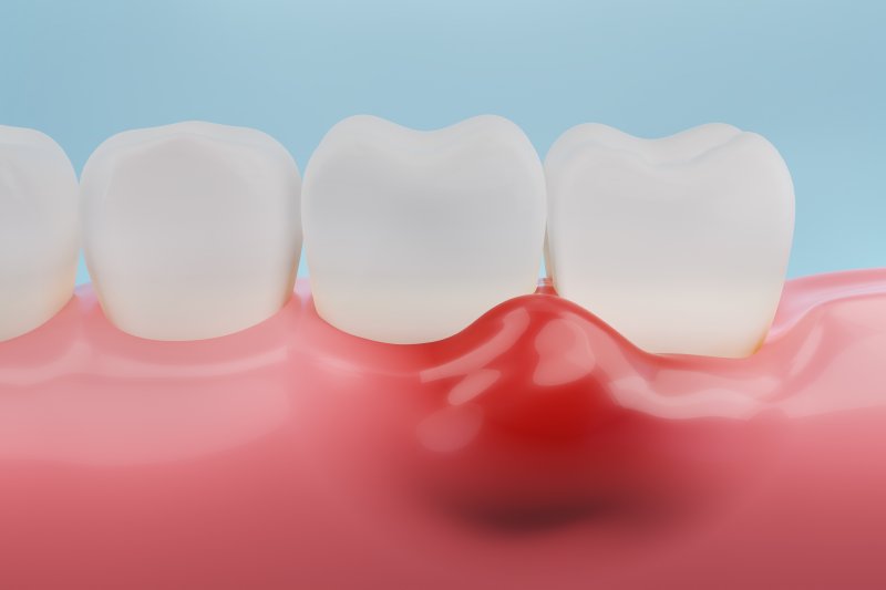 Does Gum Disease Go Away After the Teeth Are Removed?