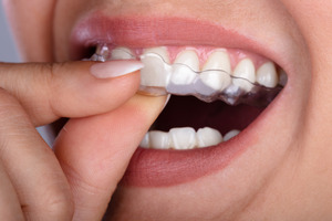 What to Do If Your CandidPro Aligner Doesn’t Fit