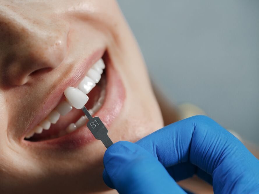 What Is Dental Bonding: A Complete Guide to the Procedure
