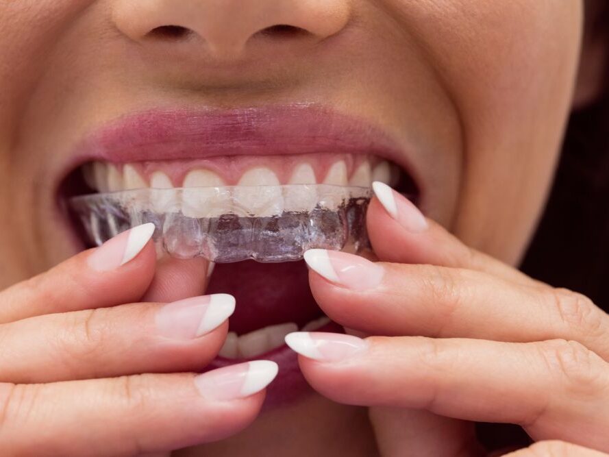 What Is the 30-Minute Rule for Invisalign?