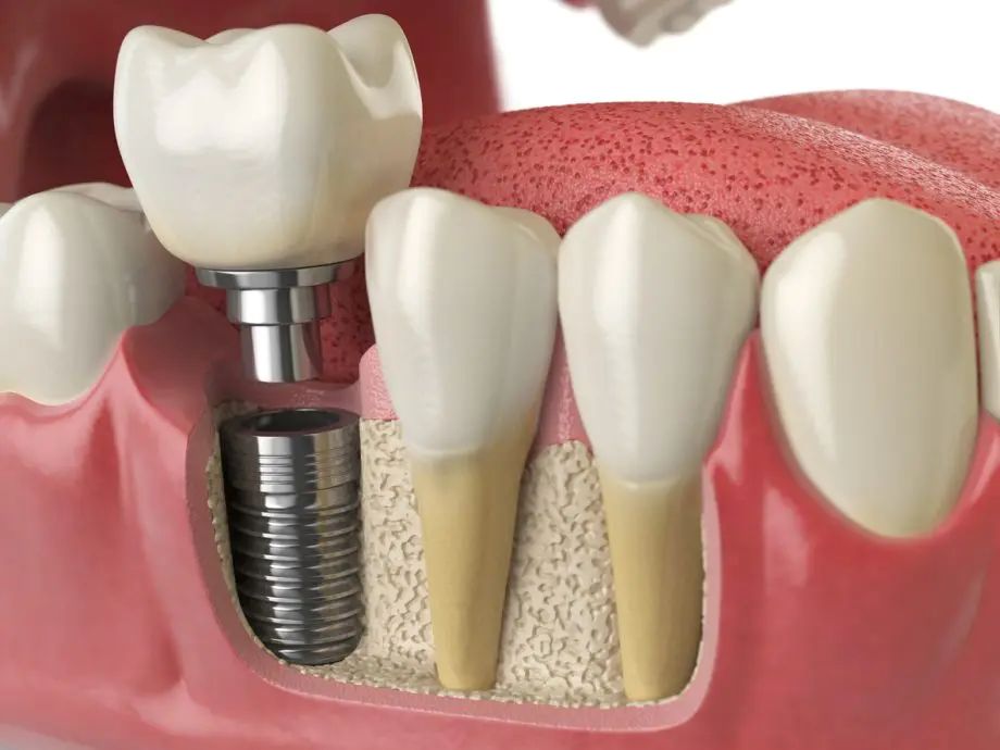 A Comprehensive Guide to Dental Implants