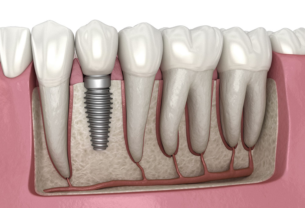 Understanding the Lifespan of Dental Implants