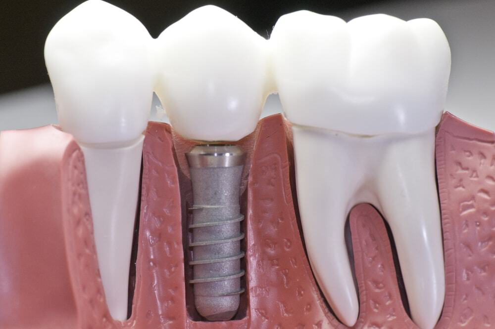Understanding How Dental Implants Work