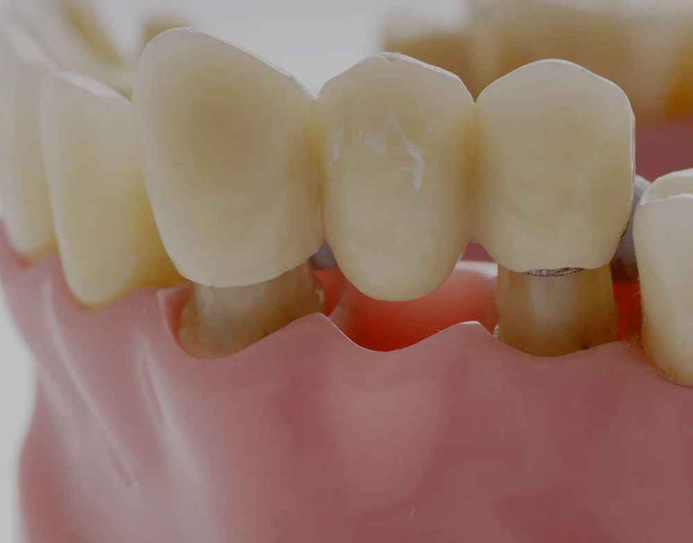 Everything You Need to Know About Dental Bridges