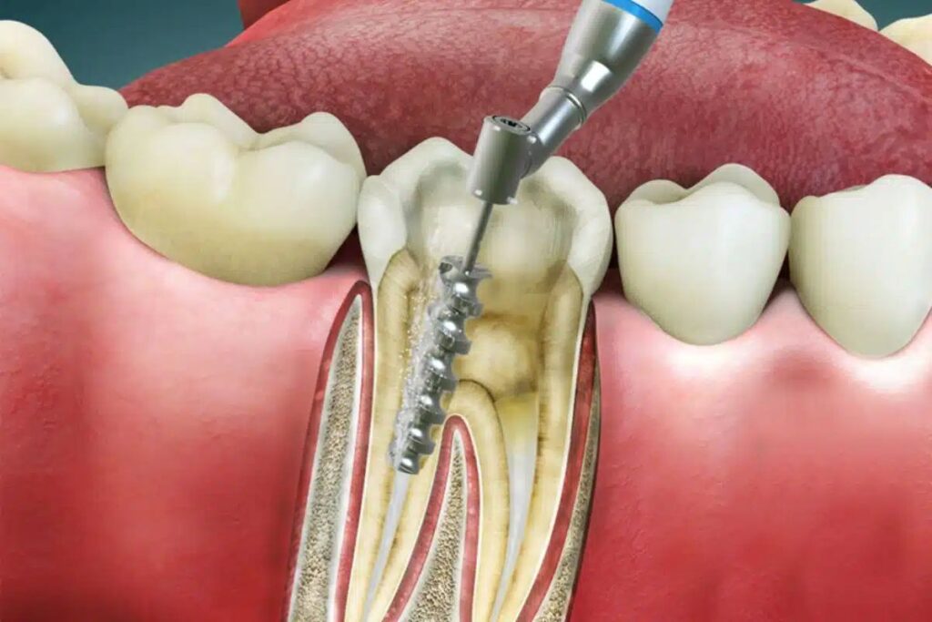 What Exactly Is Done During a Root Canal?