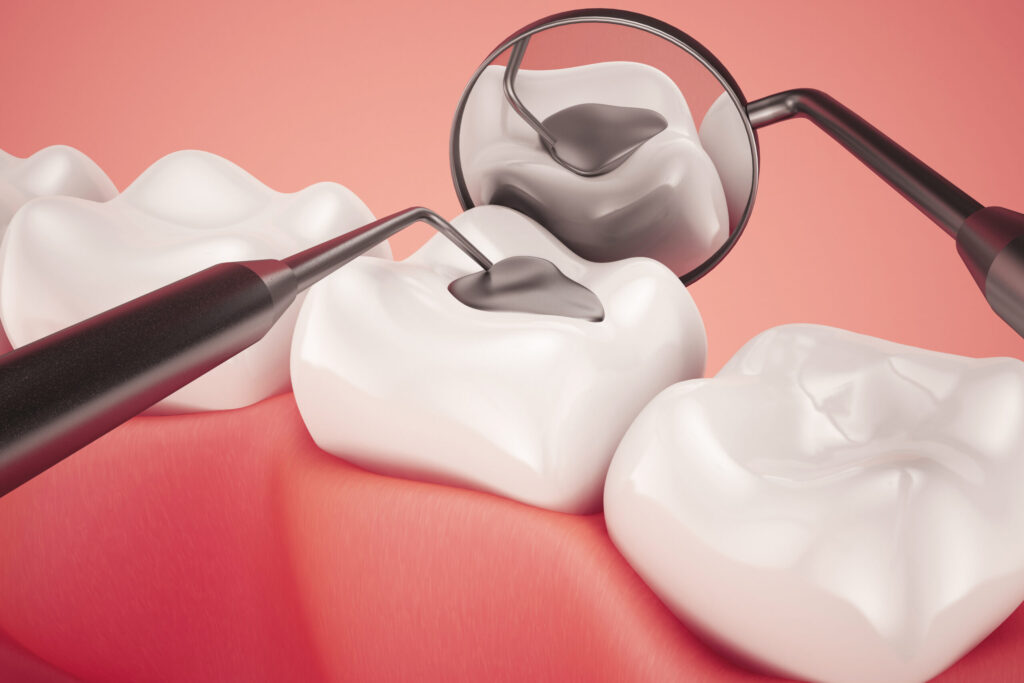 What Is a Dental Filling in Dentistry? A Simple Breakdown for Patients
