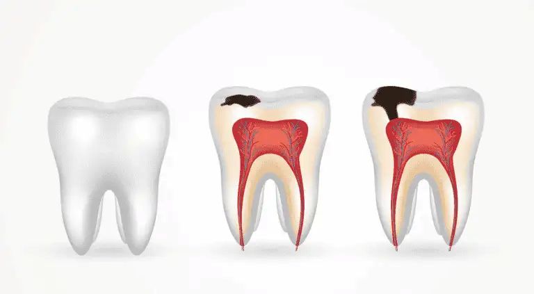 What Are Dental Caries? A Simple Breakdown for Patients