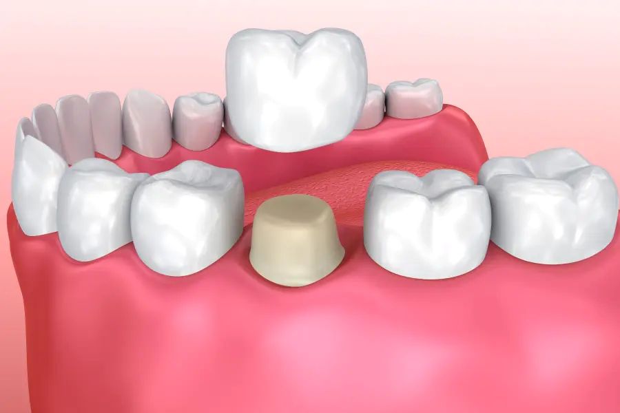How Long Do Dental Crowns Last on Average?