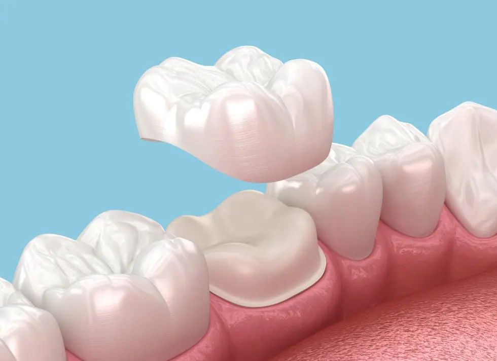 What Is a Dental Crown in Dentistry? A Clear Explanation